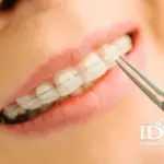What Are Ceramic Braces?