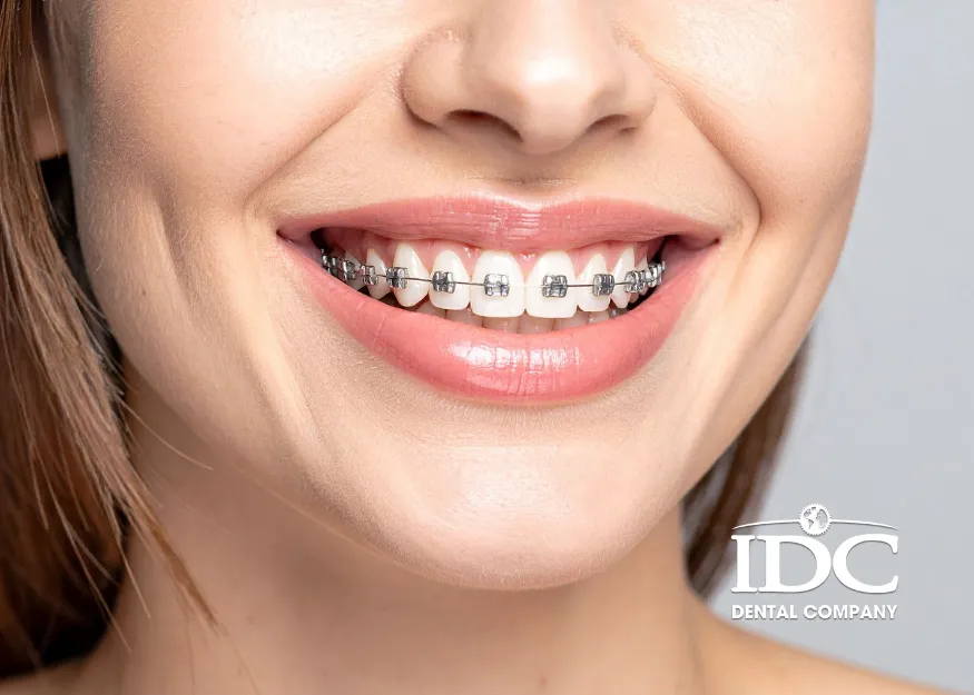 What Are Metal Braces?