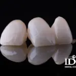 Are Porcelain Crowns Worth It?