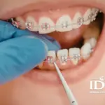 Who Should Use Orthodontic Fixed Braces?