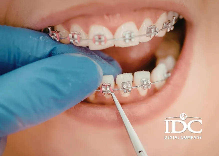 Who Should Use Orthodontic Fixed Braces?