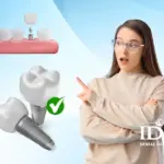 Who Is a Suitable Candidate for Dental Implants?