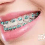 Chi phí niềng răng 2 hàm là bao nhiêu?