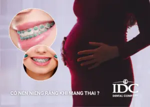 Chi phí niềng răng cho trẻ em là bao nhiêu? Có đắt không?