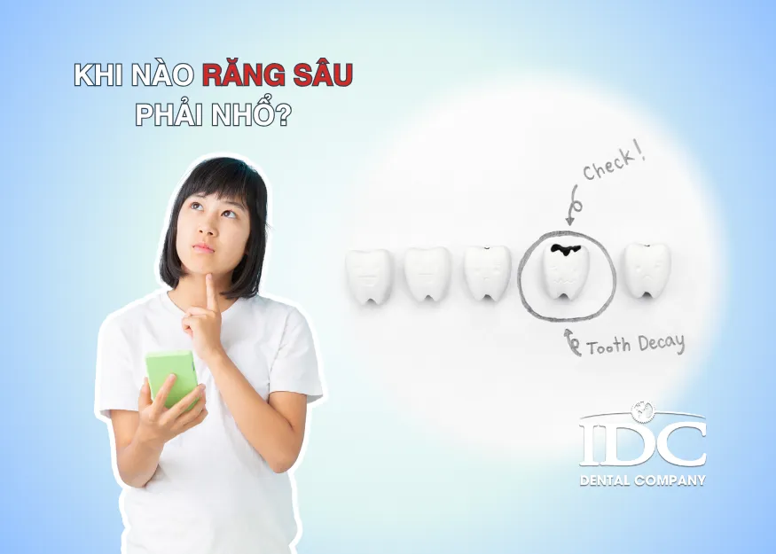 Khi nào răng sâu cần phải nhổ?