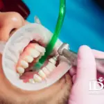 9 Lợi ích của cạo vôi răng không nên bỏ qua