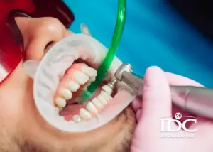 Răng bị mòn men răng phải làm sao? Nguyên nhân & cách khắc phục hiệu quả