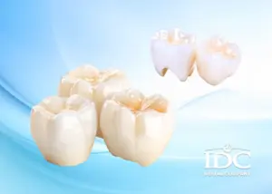 Cấu tạo trụ implant và cơ chế tích hợp xương là gì?