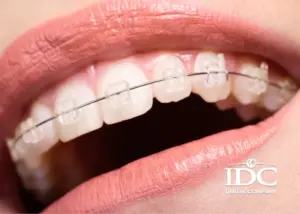 Vì sao bọc răng sứ bị đau nhức? 5 Nguyên nhân thường gặp