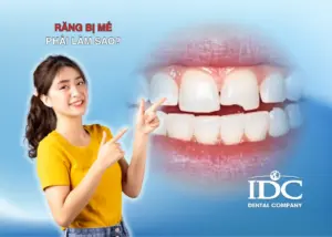 rang bi me phai lam sao