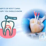 Benefits of Root Canal Therapy You Should Know