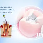 How Long Do Temporary Dental Fillings Last?