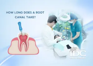 How long does a root canal take?