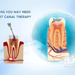 Signs You May Need Root Canal Therapy