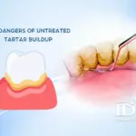 The Dangers of Untreated Tartar Buildup 11zon