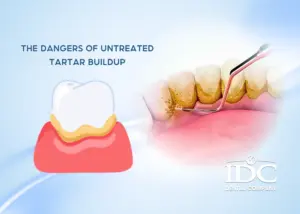 Retainers After Braces: How Long Should You Wear Them?