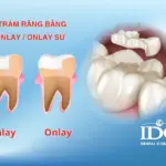 Trám răng bằng Inlay/Onlay sứ là gì?