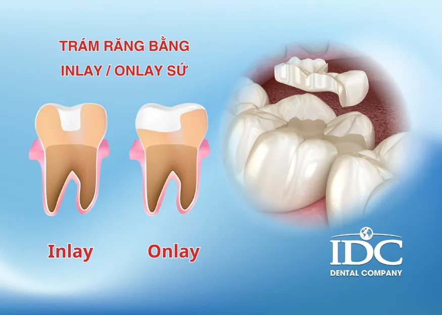 Trám răng bằng Inlay/Onlay sứ là gì?
