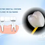 Trusted Dental Crown Clinic in Da Nang
