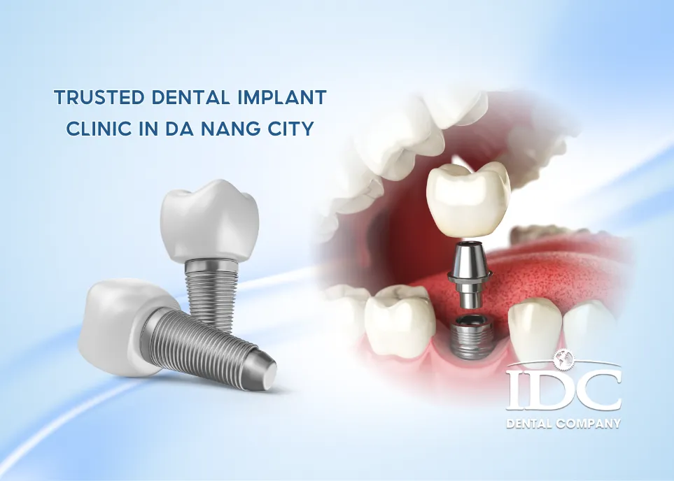 Trusted Dental Implant Clinic in Da Nang City