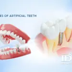 Types of Artificial Teeth