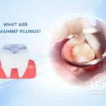 What Are Permanent Fillings?