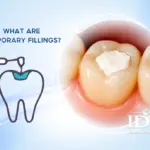 What Are Temporary Fillings?