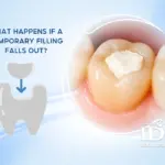 What Happens If a Temporary Filling Falls Out?