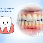 What Is Dental Fluorosis?
