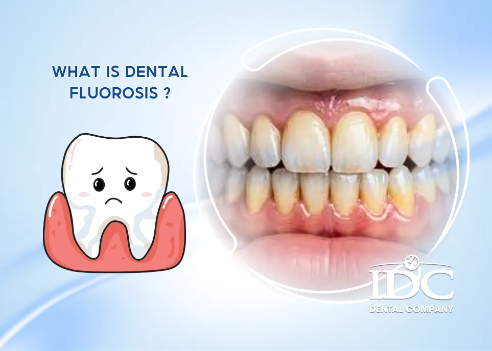 What Is Dental Fluorosis?