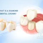 What Is a Diamond Dental Crown 11zon
