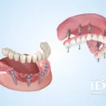 Full Mouth Dental Implants