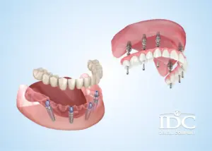 Best Swiss Dental Implant Brands in Da Nang for Premium Quality