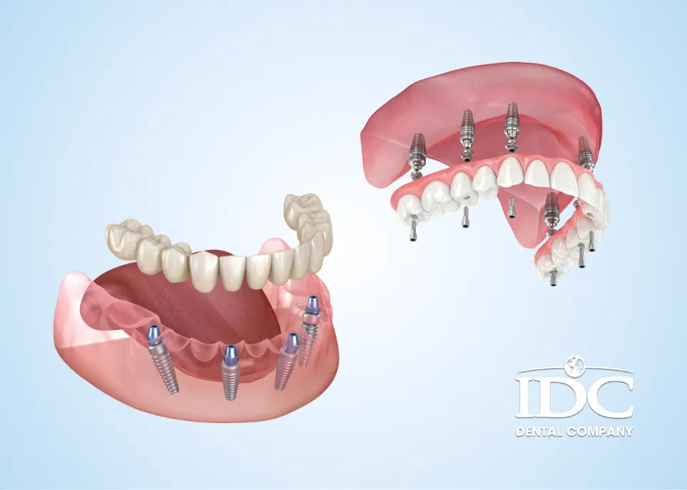 Who Is Suitable for Full-Mouth Dental Implants?