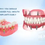 Why You Should Consider Full Mouth Implants Early 11zon