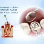 Why do dentists place temporary fillings after a root canal?