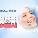 Is a Dental Bridge a Good Option?