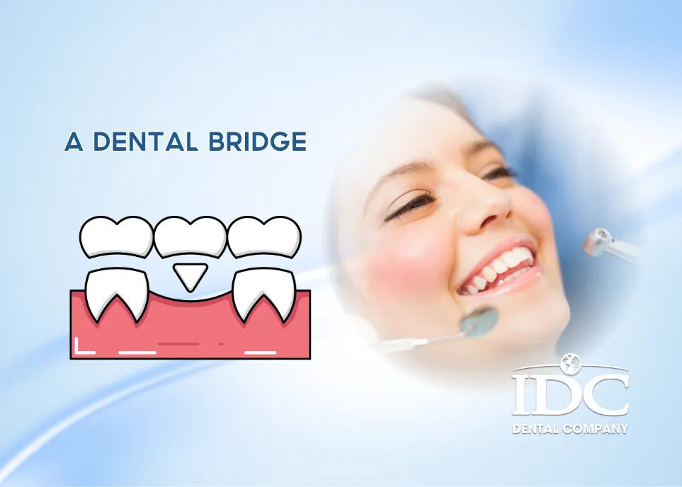 Is a Dental Bridge a Good Option?