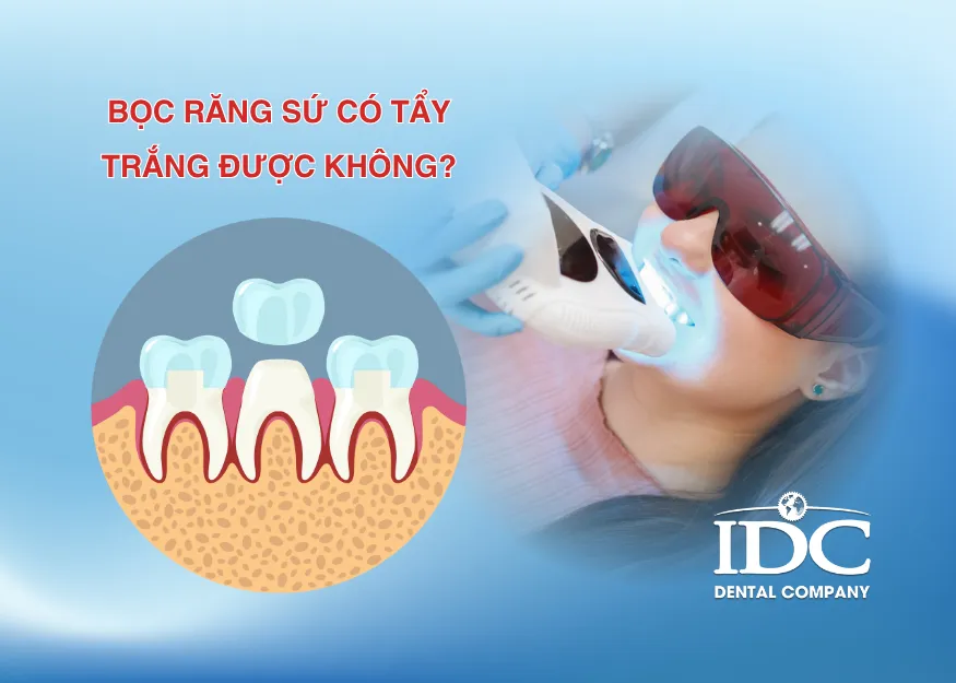 boc rang su co tay trang duoc khong