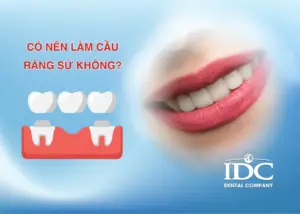 Mão răng sứ là gì? Cấu tạo, ưu nhược điểm và khi nào nên làm