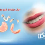 Hàm giả tháo lắp có tốt không?