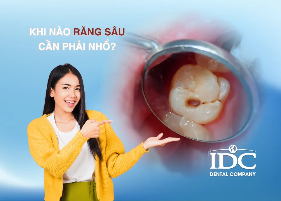 Khi nào răng sâu cần phải nhổ?