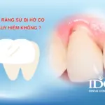 Làm răng sứ bị hở có nguy hiểm không ?