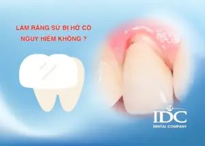 Làm răng sứ bị hở có nguy hiểm không ?