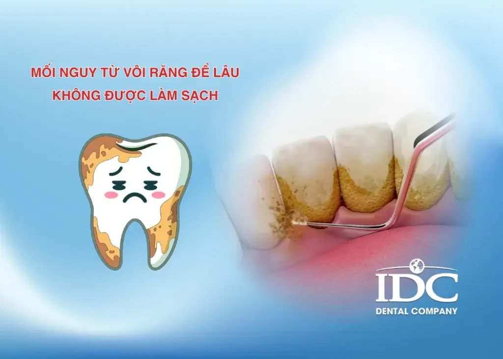 Mối nguy từ vôi răng để lâu không được làm sạch