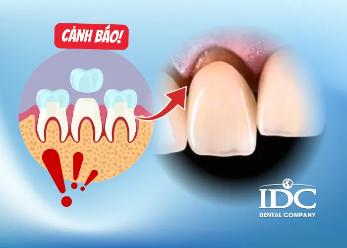 Nguyên nhân khiến răng sứ bị hở