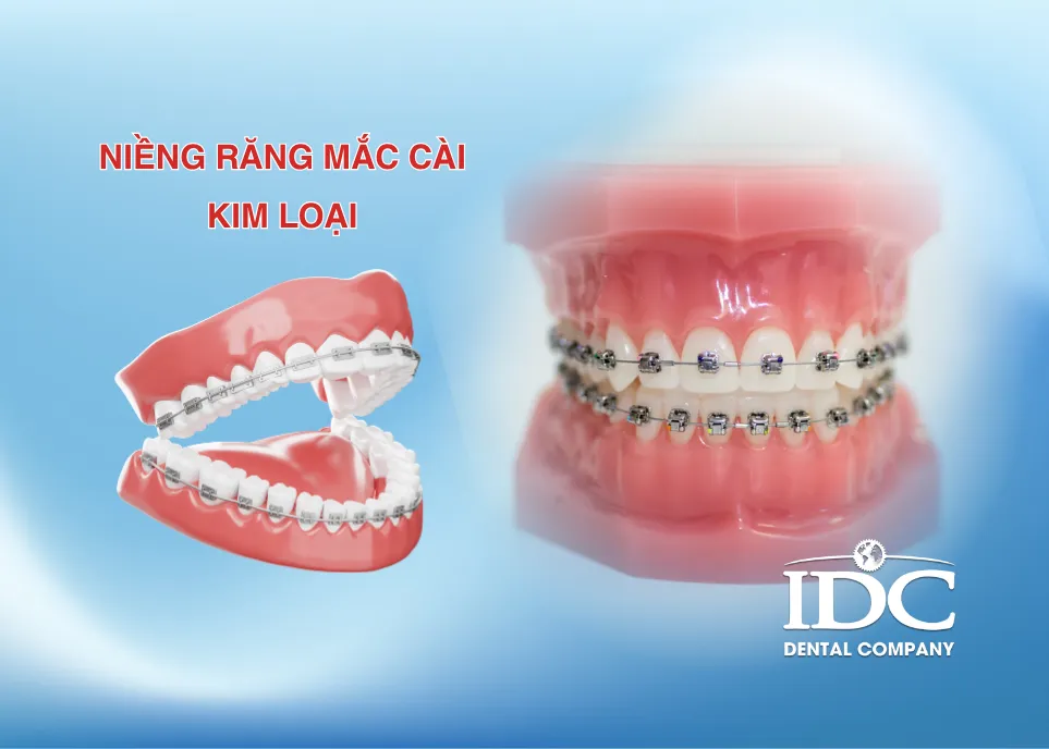Niềng răng mắc cài kim loại có tốt không?