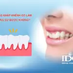 rang khap khenh co lam rang su duoc khong 11zon