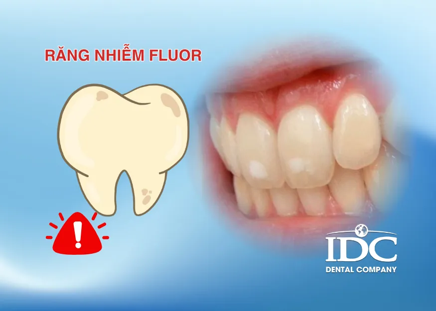 Răng nhiễm fluor có tự hết không?