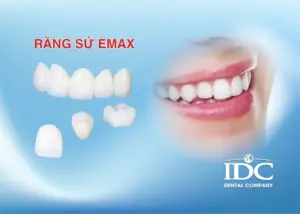 Có nên niềng răng cho trẻ 11 tuổi không? Thời điểm vàng hay không?